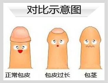 包皮包茎