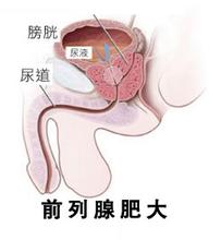 前列腺增生