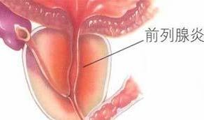 前列腺炎