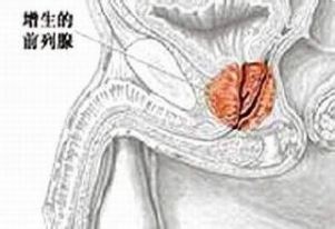 前列腺增生