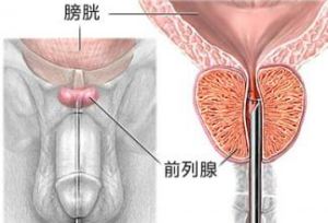 前列腺炎